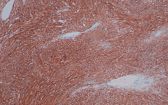 DOG1 抗体试剂(免疫组织化学)