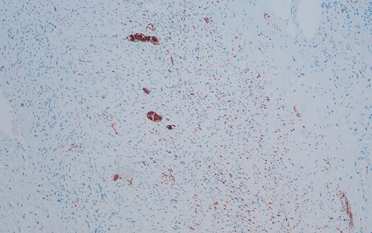 Calretinin  抗 体 试 剂 ( 免 疫 组 织 化 学 )