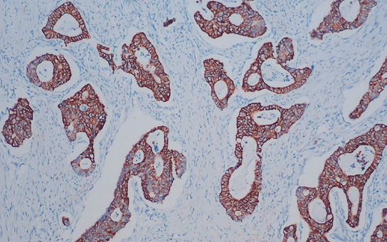 细胞角蛋白2 0 抗体试剂 ( 免 疫 组 织 化 学 )